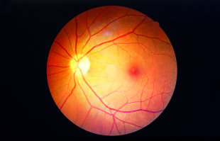 IDx-DR Eye Exam – Diabetic Retinopathy (mtmDR) detection